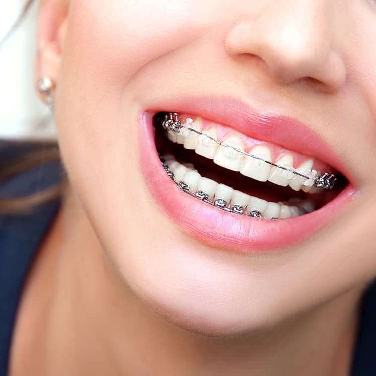 歯列矯正中のホワイトニング